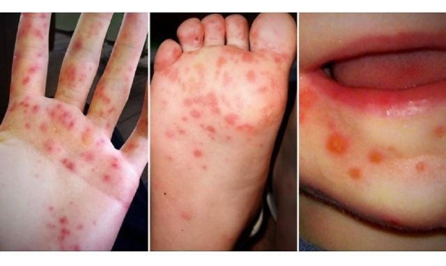 gejala flu singapura